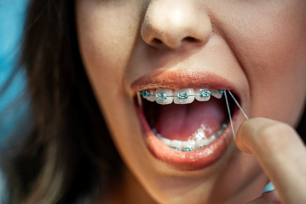 A closeup of a girl wearing rubber bands on her braces